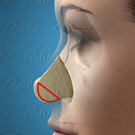 3-Lateral-long-droopy-Septum-removal