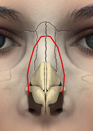 4-ideal-with-fracture-line