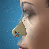 4-medial-crura-to-caudal-septum-suture