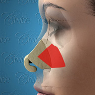 Septum areas that cause airway obstruction - side view