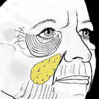 Diagram of an aging lower eyelid and cheek