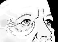 Aging lower eyelid