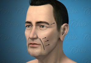 Thumbnail-Surgical-Options-300x209-landscape