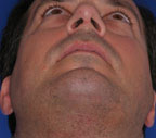 Chin Incision - male - from below