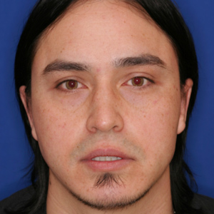 After otoplasty male - front view