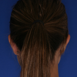 After ear surgery female - rear view