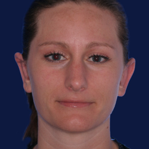 Protruding ears after otoplasty female - front view