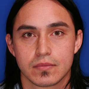 Before otoplasty male - front view
