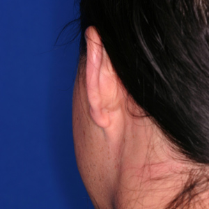Before female otoplasty - rear view