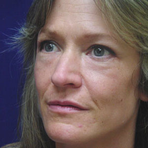 After lower eyelid surgery - angle view