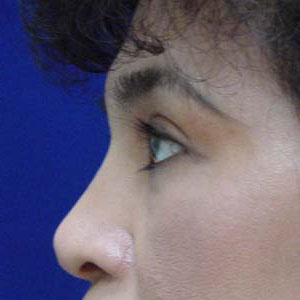 After upper eyelid surgery - side view