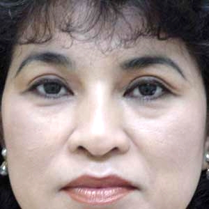 After upper blepharoplasty - front view