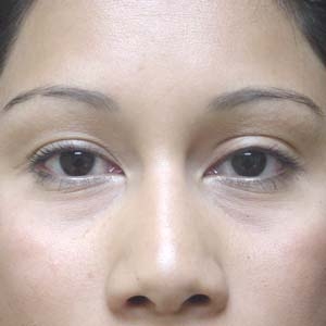 After upper eyelid correction - front view