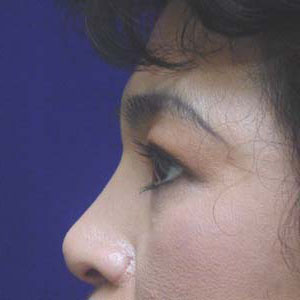 Before upper eyelid surgery - side view