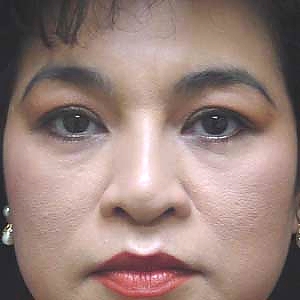 Before upper blepharoplasty - front view