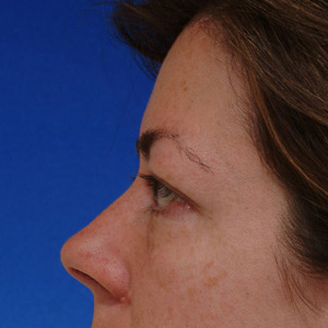 Before browlift and excess skin removal - side view