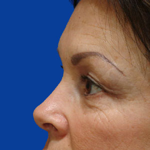 Before upper eyelid surgery - side view