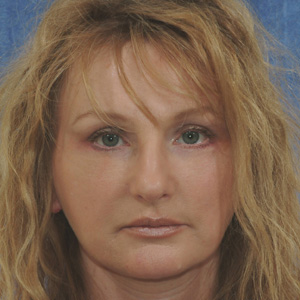 After face lift - front view