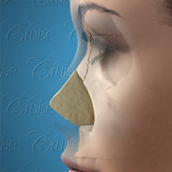 ideal-septum-profile
