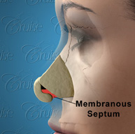 membrenous-septum