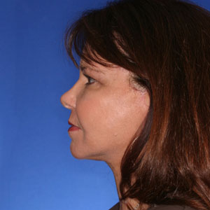 necklift_After12