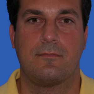 necklift_After14