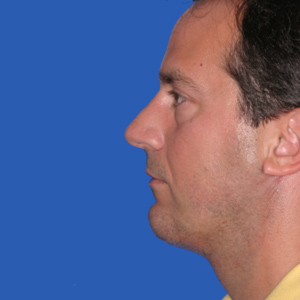 necklift_After15