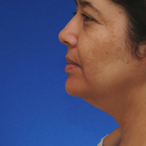 Before neck lift - side view