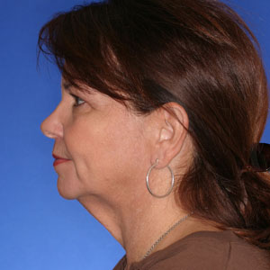 necklift_Before12