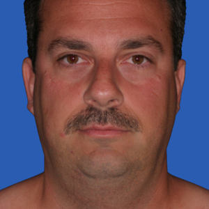 necklift_Before14