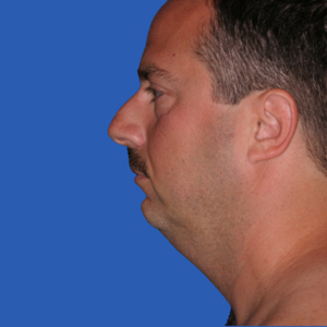 necklift_Before15