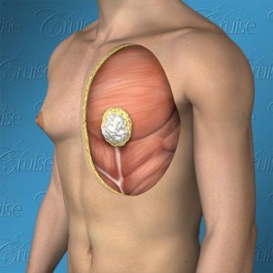 puffy-gynecomastia-300x300-circle