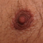 Joseph T Cruise, MD's gynecomastia nipple incision 