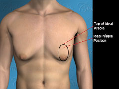 Diagram of nipple incision to correct severe saggy gynecomastia