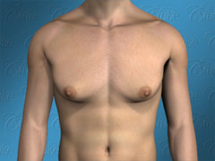 Diagram mild saggy gynecomastia - front view
