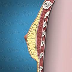 Nipple placement in fatty gynecomastia