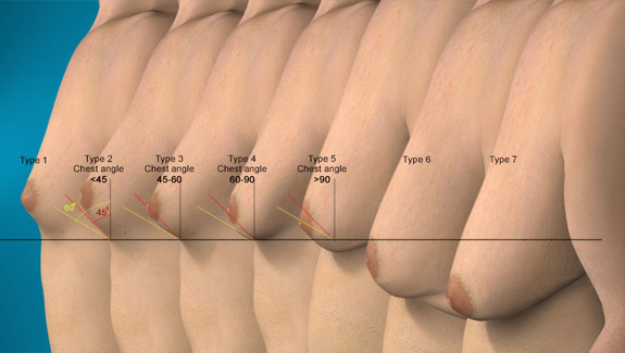 Diagram of 7 types of Gynecomastia