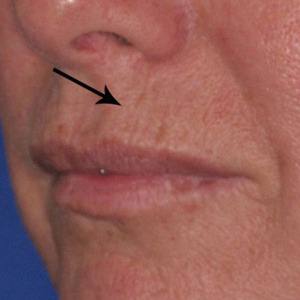 before photo of wrinkles around the mouth