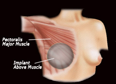 Implant Above Muscle