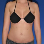 Traditional Tummy Tuck Incision 