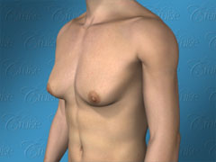Will Liposuction Alone Correct Gynecomastia? Gynecomastia Surgery in Los Angeles