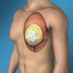 Los Angeles Gynecomastia 