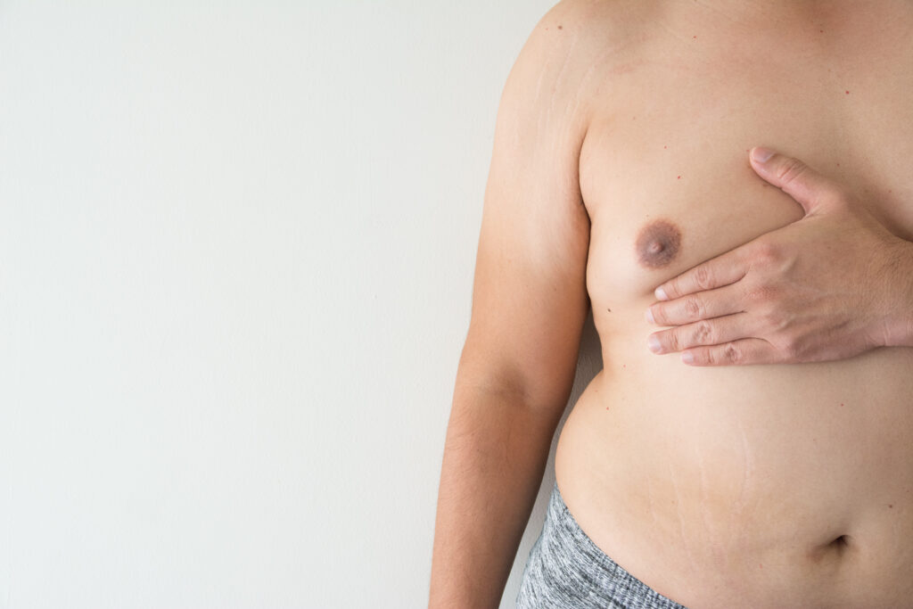 gynecomastia male man boobs