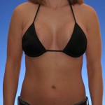 Patient After Revision Breast Surgery 