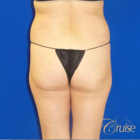 Brazilian Butt Lift Before