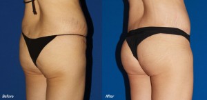 Orange County Brazilian Butt Lift Patient 