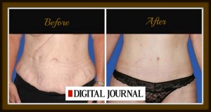 Orange County Tummy Tuck