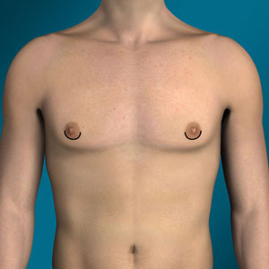 Incision for gynecomastia type 2, around areola