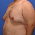 gynecomastia-type-5s