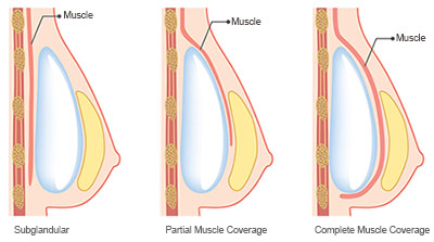 implant placement